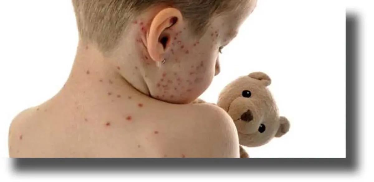 Ενημέρωση για την ιλαρά από τον Εθνικό Οργανισμό Δημόσιας Υγείας (ΕΟΔΥ)