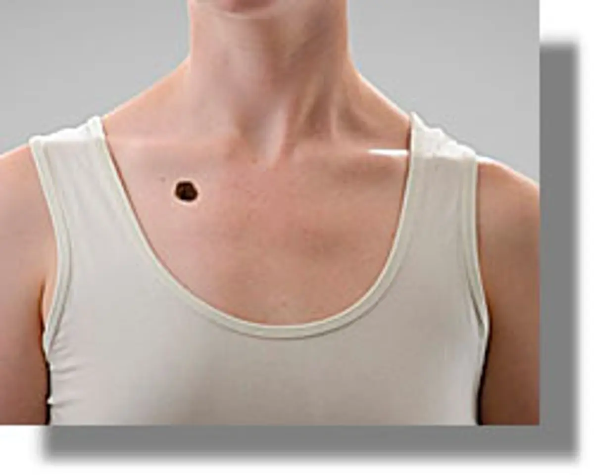 Καρκίνος δέρματος